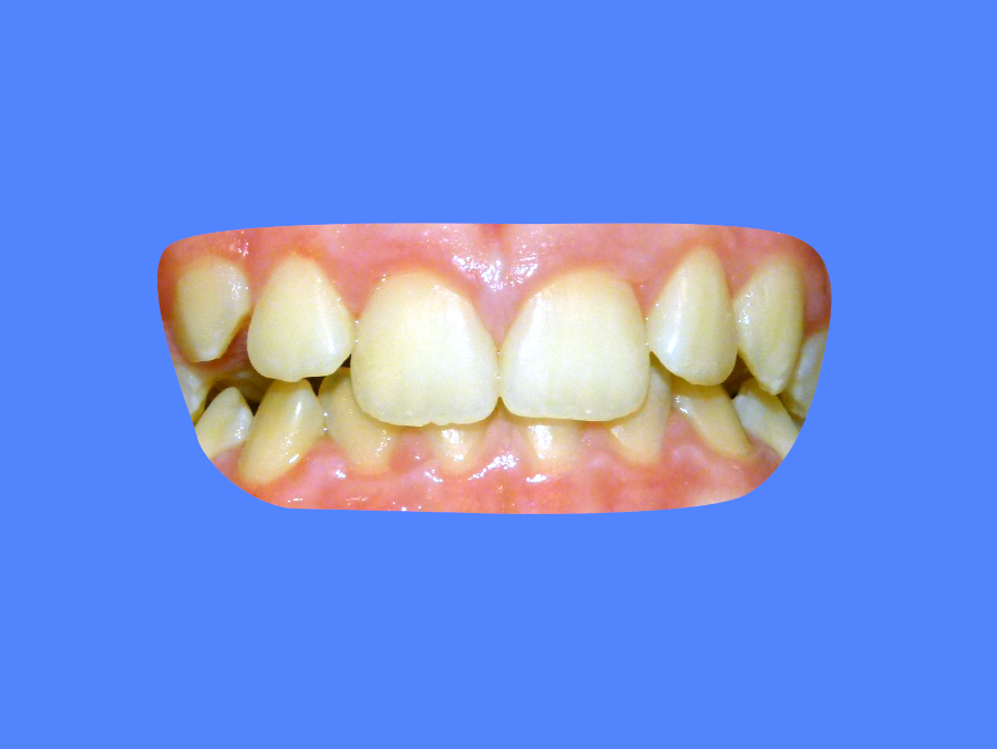 Before image showing patient with misaligned teeth